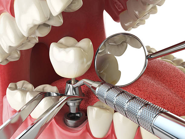 Best Dental Abscess Treatment in Bargersville, IN
